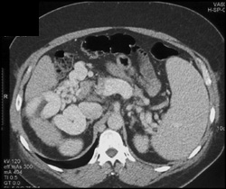 Cavernous Transformation of the Portal Vein - CTisus CT Scan