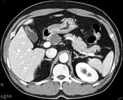 Hepatic Artery Aneurysm - CTisus CT Scan