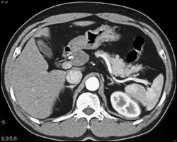 Hepatic Artery Aneurysm - CTisus CT Scan