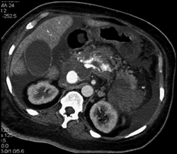 Fistulae From Portal Vein to Artery - CTisus CT Scan