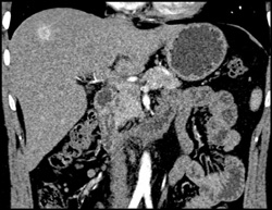 Hemangioma - CTisus CT Scan