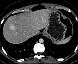 Hemangioma - CTisus CT Scan