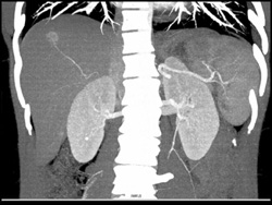 Hemangioma - CTisus CT Scan