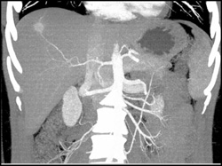 Hemangioma - CTisus CT Scan