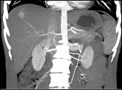 Hemangioma - CTisus CT Scan