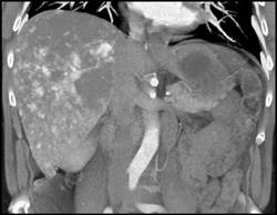 Giant Hemangioma - CTisus CT Scan