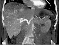 Giant Hemangioma - CTisus CT Scan