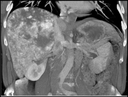 Giant Hemangioma - CTisus CT Scan