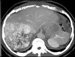 Giant Hemangioma - CTisus CT Scan