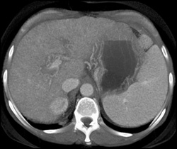 Cirrhosis With Varices - CTisus CT Scan