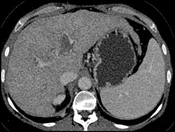 Cirrhosis With Varices - CTisus CT Scan