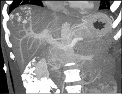 Hemangioma - CTisus CT Scan