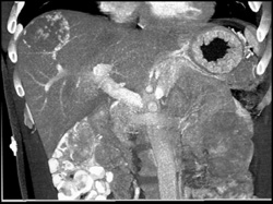 Hemangioma - CTisus CT Scan