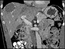 Hemangioma - CTisus CT Scan