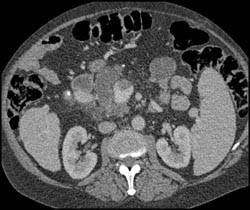 Intraductal Papillary Mucinous Neoplasm (IPMN) Invades the Portal Vein - CTisus CT Scan