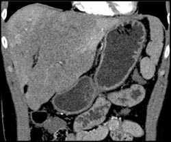 Patchy Liver Enhancement Due to Portal Vein Thrombosis (PVT) - CTisus CT Scan