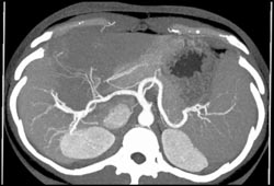 Stretching of Arterial Vessels Due to Hepatic Congestion - CTisus CT Scan