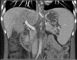 Hepatic Congestion With Patchy Enhancement - CTisus CT Scan