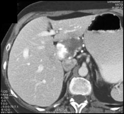 Hemangioma - CTisus CT Scan