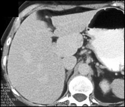 Hemangioma Fills In - CTisus CT Scan