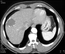 Hemangioma - CTisus CT Scan