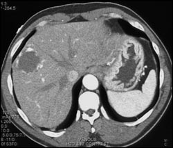 Hemangioma - CTisus CT Scan