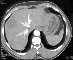 Hemangioma - CTisus CT Scan