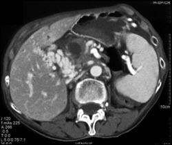 Cavernous Transformation of the Portal Vein (CTPV) - CTisus CT Scan