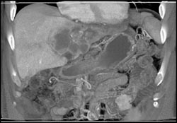 Cholangiocarcinoma - CTisus CT Scan