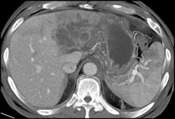 Cholangiocarcinoma - CTisus CT Scan