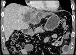 Cholangiocarcinoma - CTisus CT Scan