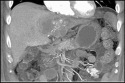 Cholangiocarcinoma - CTisus CT Scan