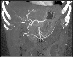 Cholangiocarcinoma - CTisus CT Scan