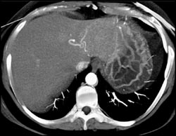 Cholangiocarcinoma - CTisus CT Scan