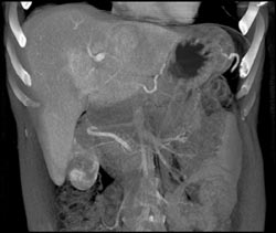 Cholangiocarcinoma - CTisus CT Scan