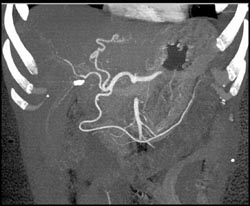 Cholangiocarcinoma - CTisus CT Scan