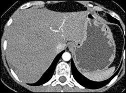 Cholangiocarcinoma - CTisus CT Scan