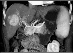 Hepatoma - CTisus CT Scan