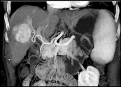 Hepatoma - CTisus CT Scan