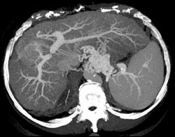 Hepatoma - CTisus CT Scan