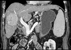 Hepatoma - CTisus CT Scan