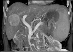 Hepatoma - CTisus CT Scan