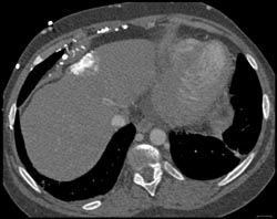 Hot Spot Liver Due to SVC Occlusion - CTisus CT Scan