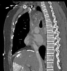 Hot Spot Liver Due to SVC Occlusion - CTisus CT Scan