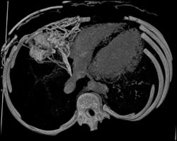 Hot Spot Liver Due to SVC Occlusion - CTisus CT Scan