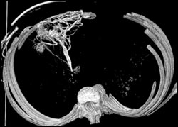 Hot Spot Liver Due to SVC Occlusion - CTisus CT Scan