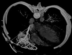 Hot Spot Liver Due to SVC Occlusion - CTisus CT Scan