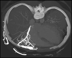 Hot Spot Liver Due to SVC Occlusion - CTisus CT Scan