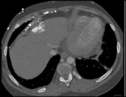 Hot Spot Liver Due to SVC Occlusion - CTisus CT Scan