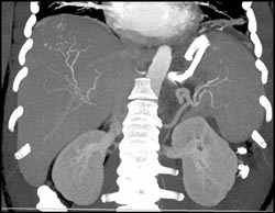 Hemangioma - CTisus CT Scan